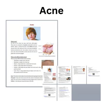 Acne Reading Comprehension Passage and Questions | 6th, 7th, 8th Grade, image 2